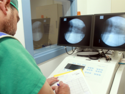 Más del 70% de las piedras en el riñón se extraen ya sin cirugía